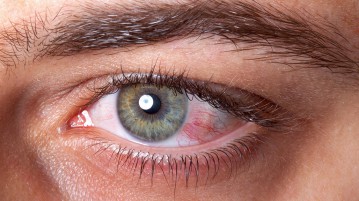 how to prevent dry eyes with contacts