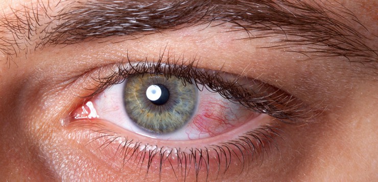 how to prevent dry eyes with contacts